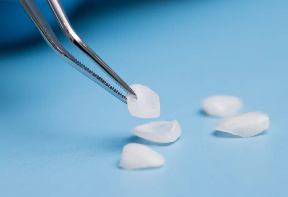 Close up of veneers being picked up on tweezer